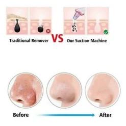 DISPOSITIVO RICARICABILE PER PULIZIA VISO PORI MACCHIE SCURE PUNTI NERI Q-M300