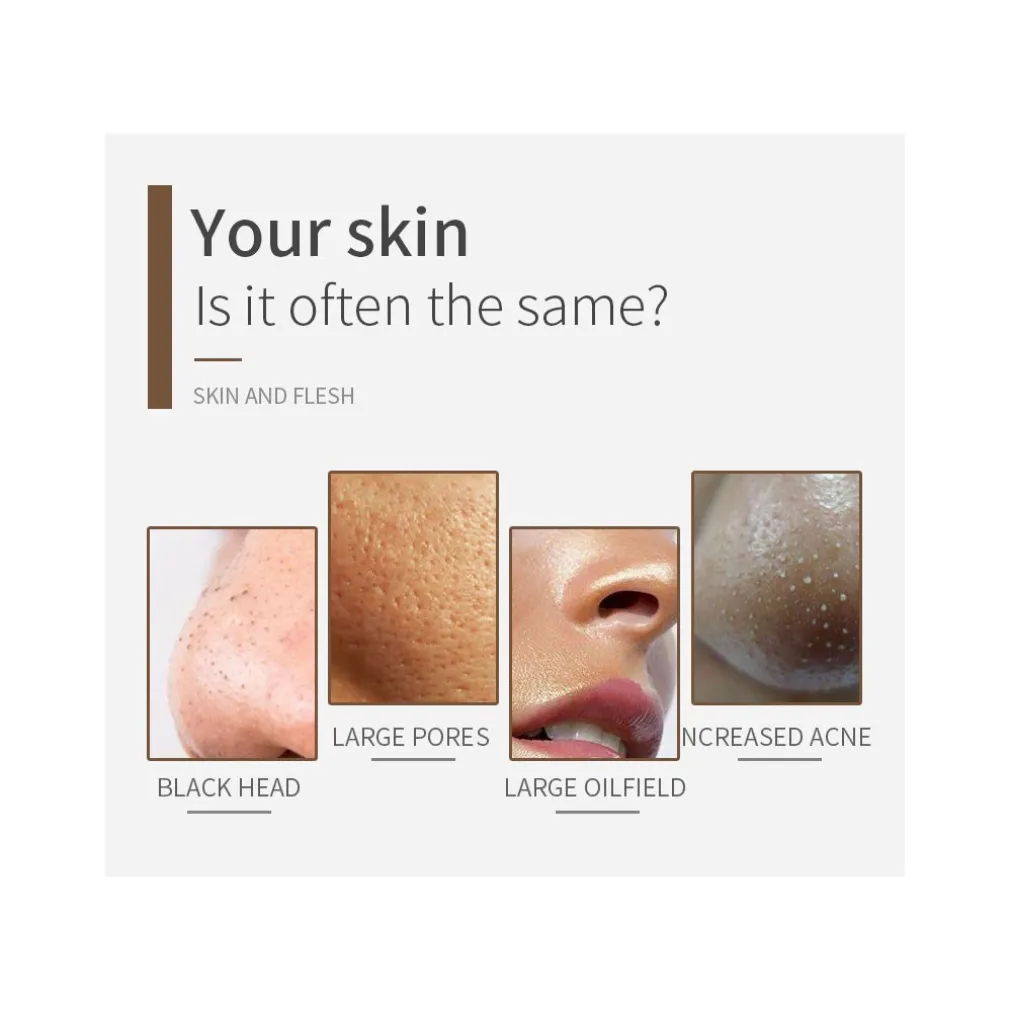 DISPOSITIVO STRUMENTO DI ASPIRAZIONE PER LA PULIZIA DEI PUNTI NERI VISO Q-M303