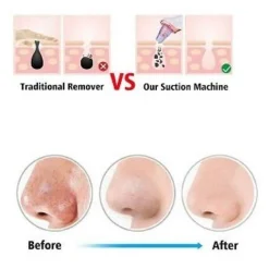 DISPOSITIVO STRUMENTO DI ASPIRAZIONE PER LA PULIZIA DEI PUNTI NERI VISO Q-M303