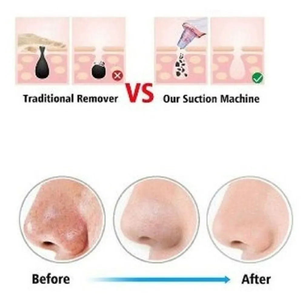 DISPOSITIVO STRUMENTO DI ASPIRAZIONE PER LA PULIZIA DEI PUNTI NERI VISO Q-M303